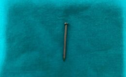 2 yaşındaki çocuğun midesinden yuttuğu çivi endoskopik yöntemle çıkarıldı