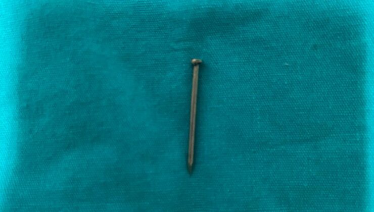 2 yaşındaki çocuğun midesinden yuttuğu çivi endoskopik yöntemle çıkarıldı